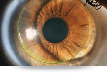 Adelgazamiento de la cornea
