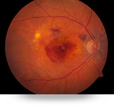 Degeneración Macular