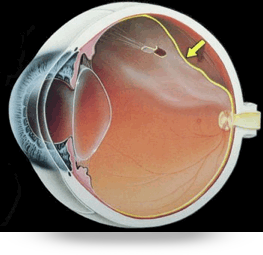 Desprendimiento de retina