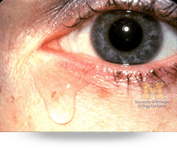 Infección del saco lagrimal