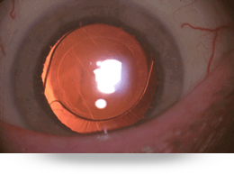 oftalmología-lacatarata