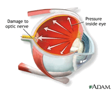 oftalmologia-glaucoma