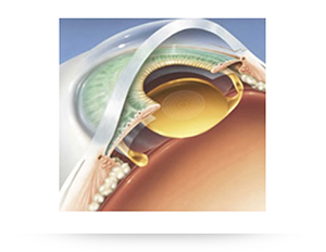 oftalmologia lentes multifocales