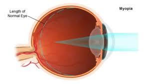 Oftalmologia - Miopia