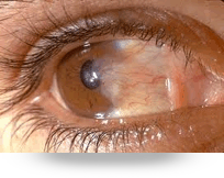 Pterigion Carnosidad