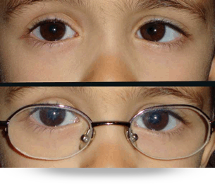 Tratamiento de Estrabismo